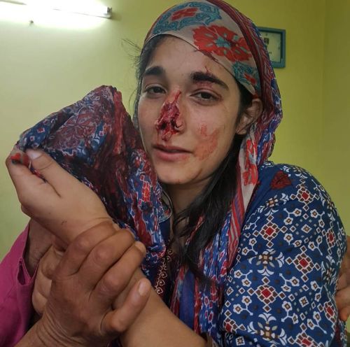 Street dog mauls six people including two women