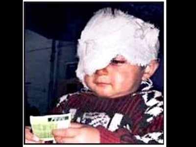 Doctors unsure if Kashmir’s youngest pellet victim will regain complete sight