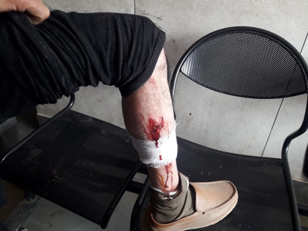 Stray dogs unleashes terror in Baramulla, injure 50