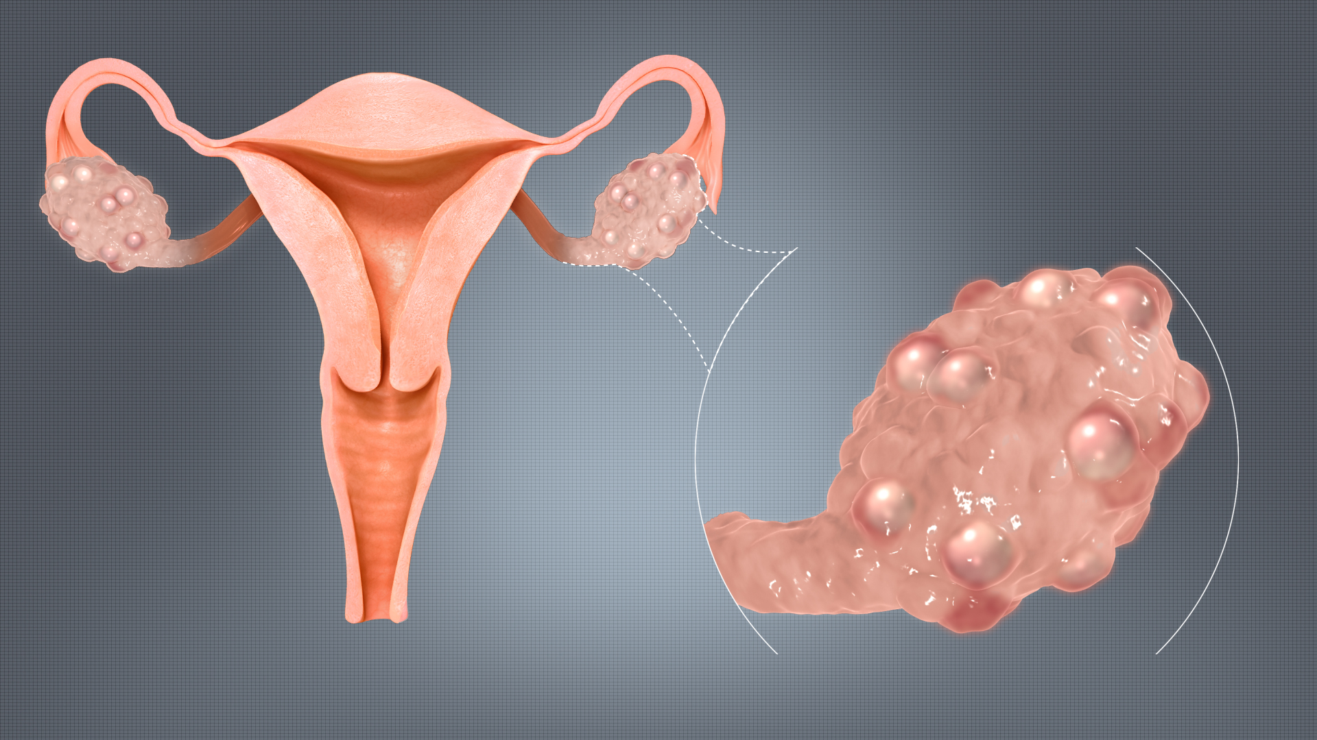 Understanding ‘Lean Polycystic Ovarian Syndrome’ and its diagnosis