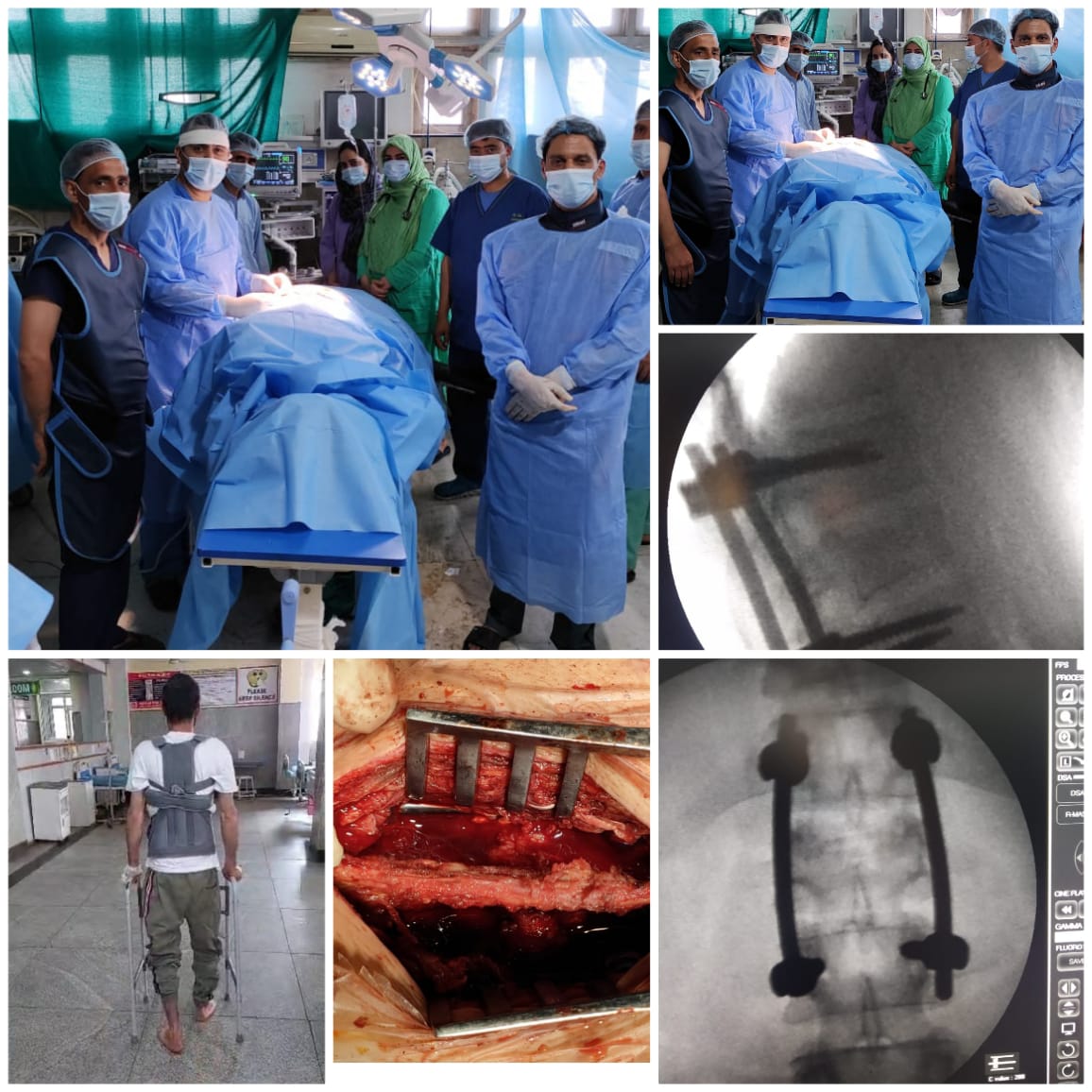 Complex spine surgery successfully conducted at DH Kulgam