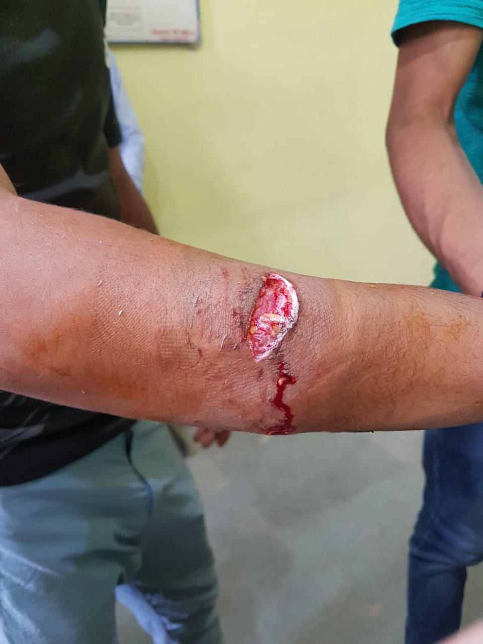 Rabid dog bites 17 people in Narwav Baramulla