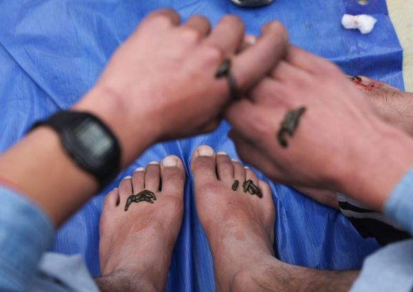 On Navroz, hundreds rush for leech therapy