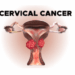 Prevention of Cervical Cancer in India