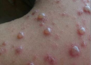 Outbreak of Chickenpox forces closure of school