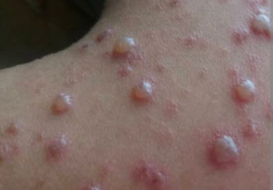 Outbreak of Chickenpox forces closure of school