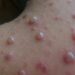 Outbreak of Chickenpox forces closure of school