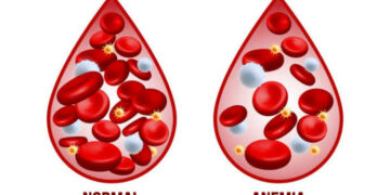 Over 72% of under-five children in J&K anaemic