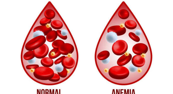 Over 72% of under-five children in J&K anaemic