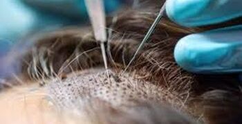 Lashkar terrorist goes for hair transplant after infiltrating J&K
